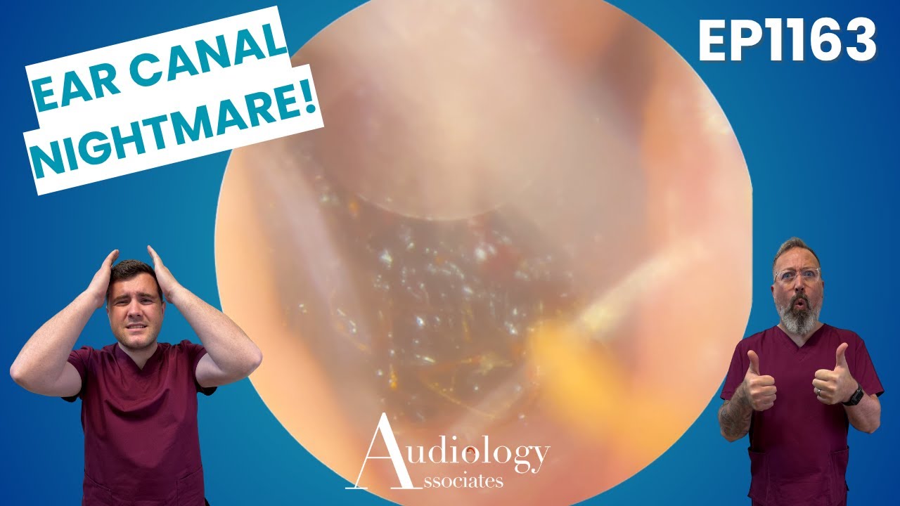Extreme Ear Wax Removal | Narrow Canal Challenge! - EP1163